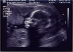ultrasound1